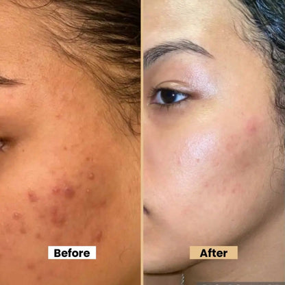 Anti Acne Cream for Pimples, Scars & Blemishes – Aloe Vera, Neem, Zinc Oxide – 12gm